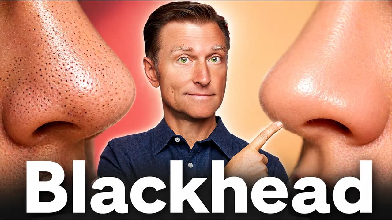 The #1 Remedy for Blackheads That Actually Works