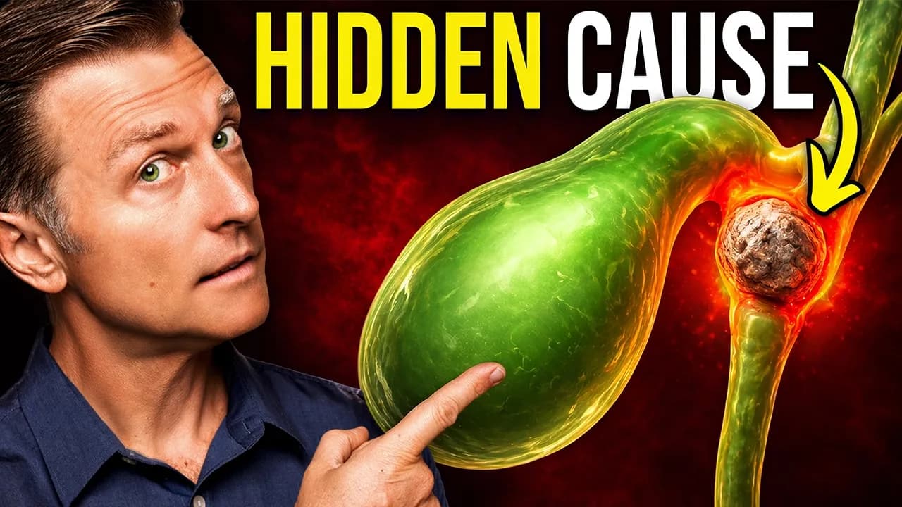 The Gallstone Mistake That Leads to SURGERY (700,000 a Year)